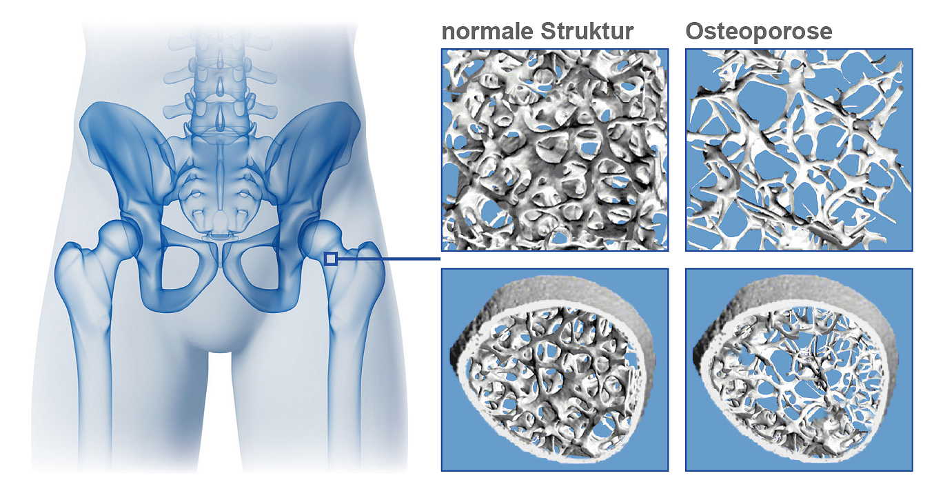 osteoporose erkennen und verstehen